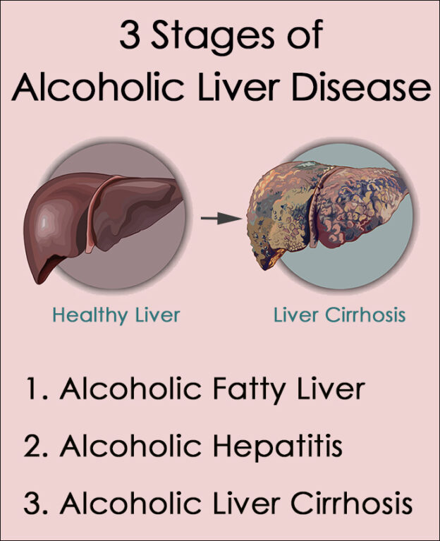 Alcoholic Liver Disease Symptoms, Stages, Treatment - Summit Rehab