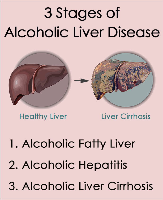 3 Stages of Alcoholic Liver Disease